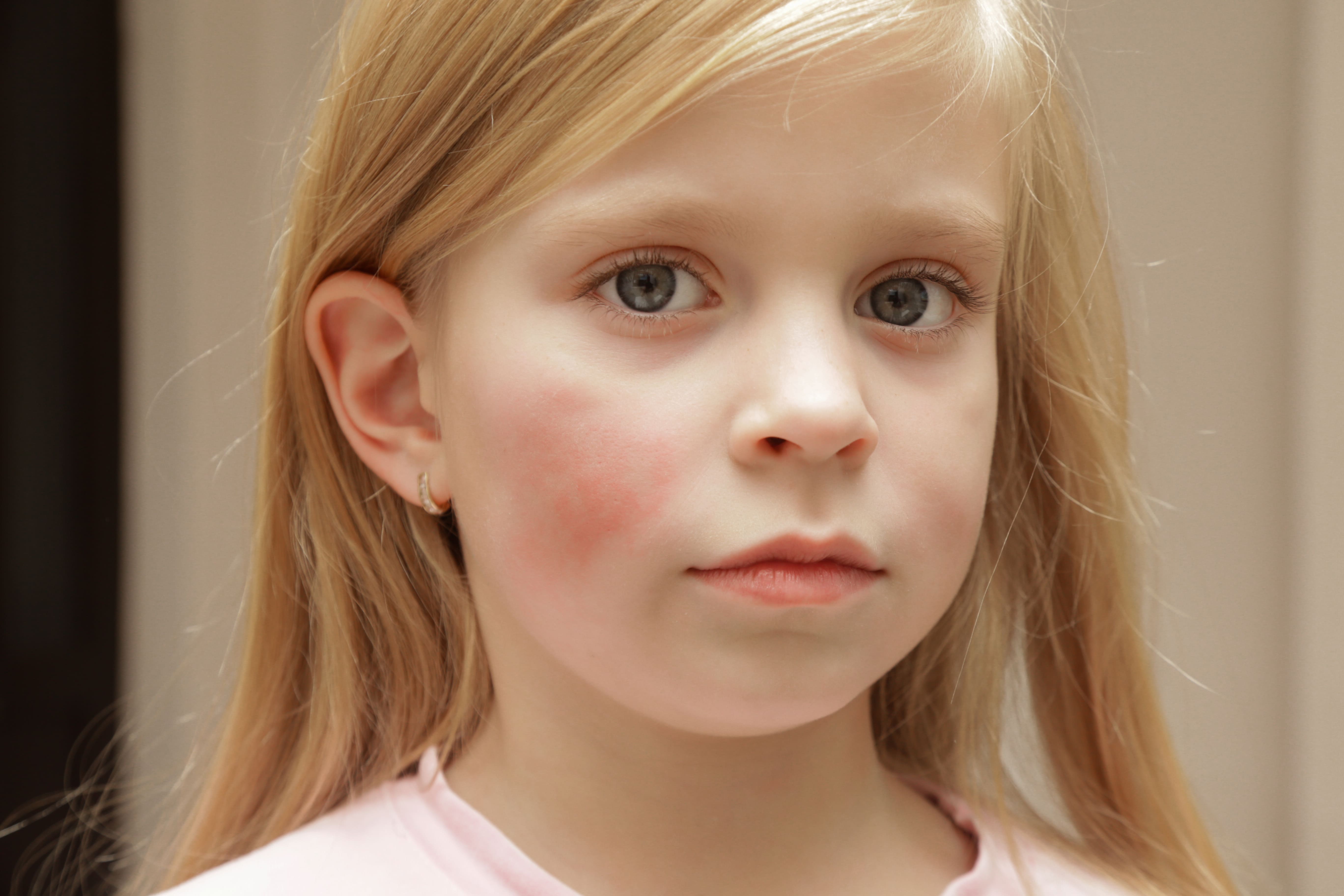 Understanding Fifth Disease (Erythema Infectiosum)