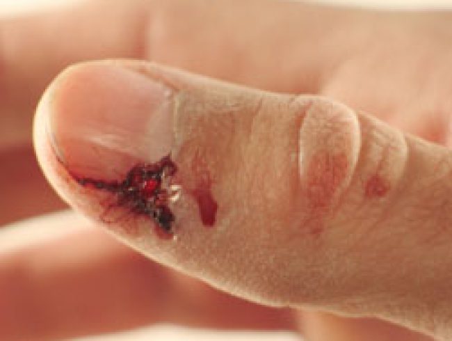 Image d'une blessure au doigt \ Image of a finger wound