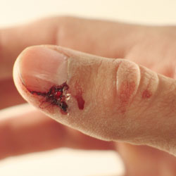 Image d'une blessure au doigt \ Image of a finger wound