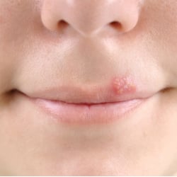 Q: My son keeps getting cold sores. How can I help to prevent them?