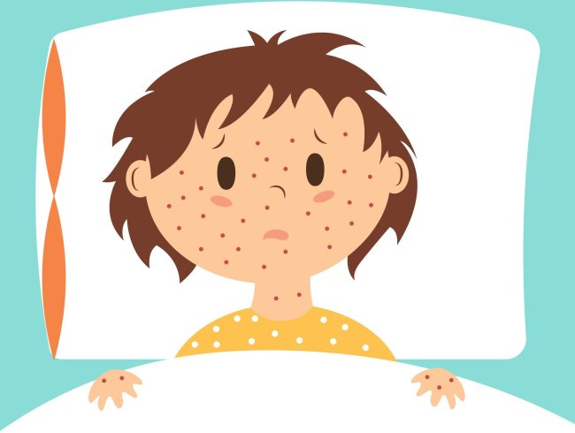Measles: what you need to know