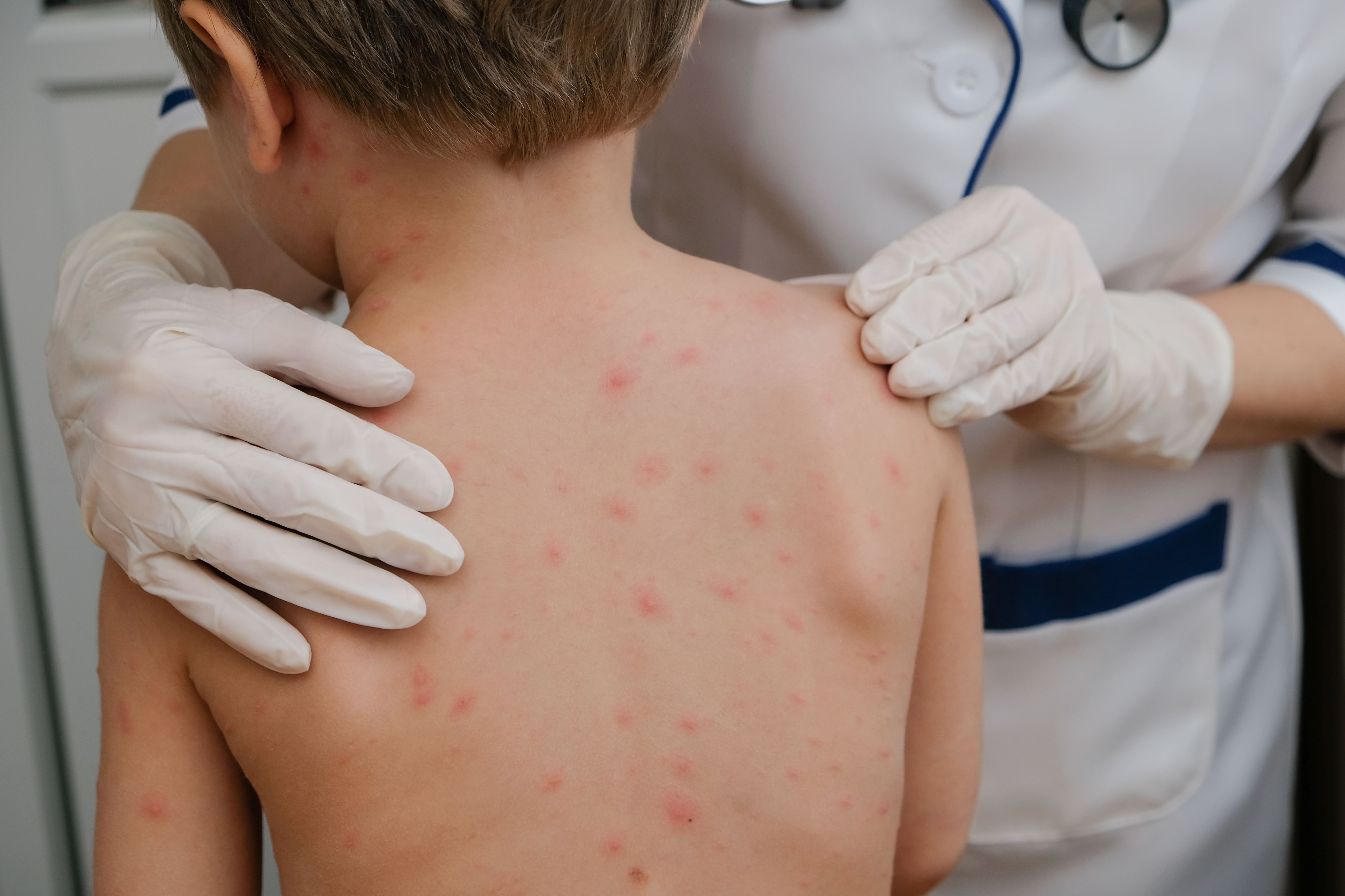 Important notice: Potential exposure to chickenpox at the Montreal Children’s Hospital